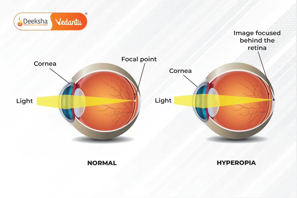 Correction of Hypermetropia