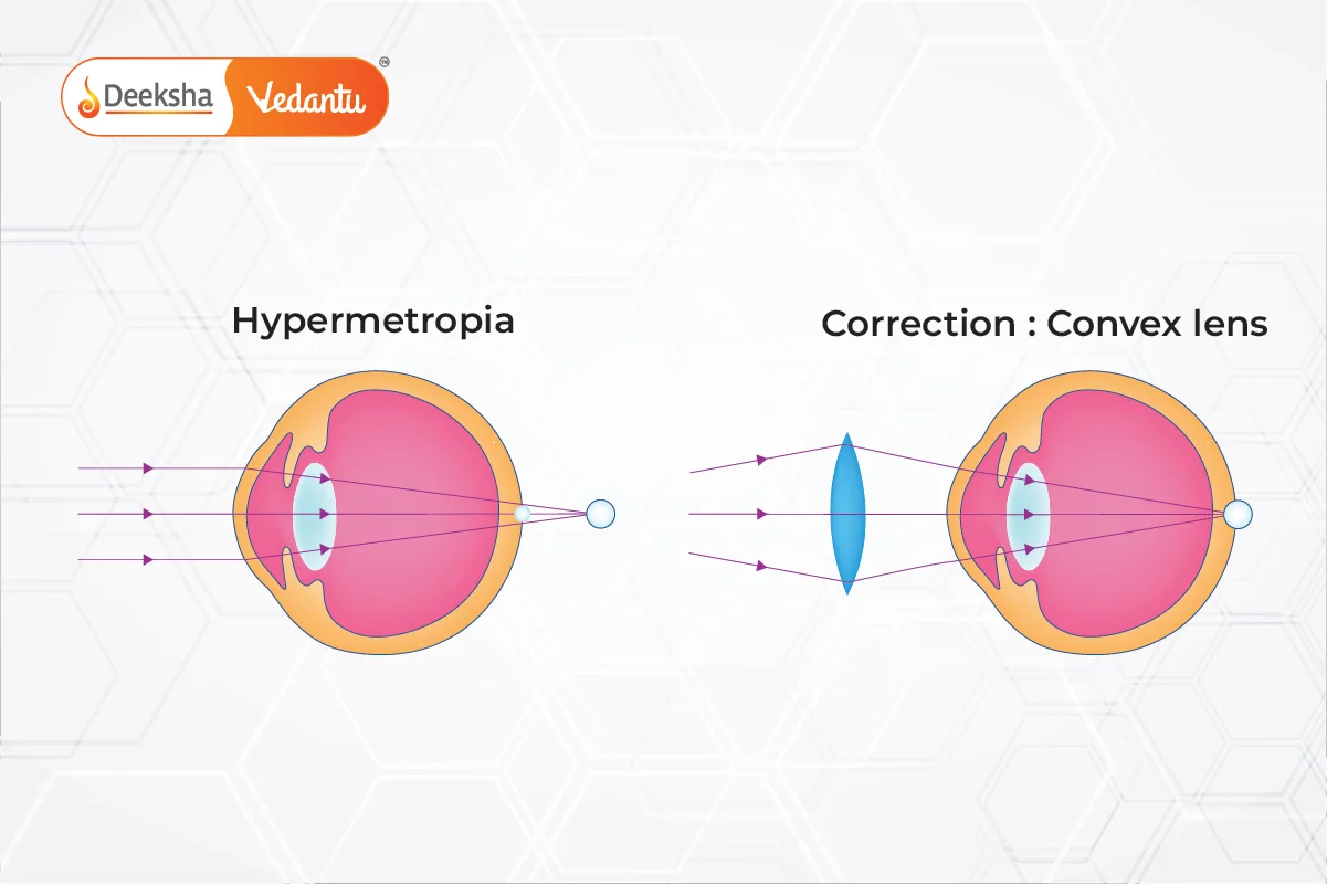 Correction of Hypermetropia