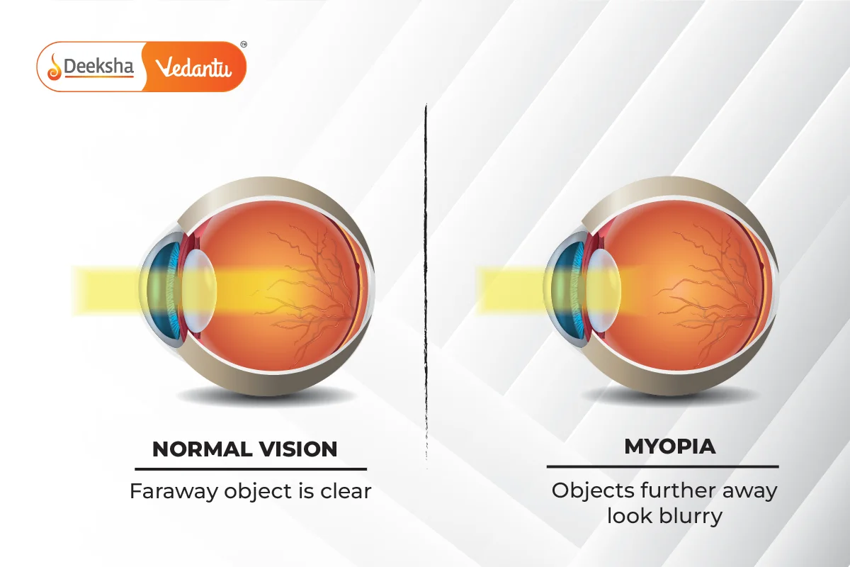 Correction of Myopia