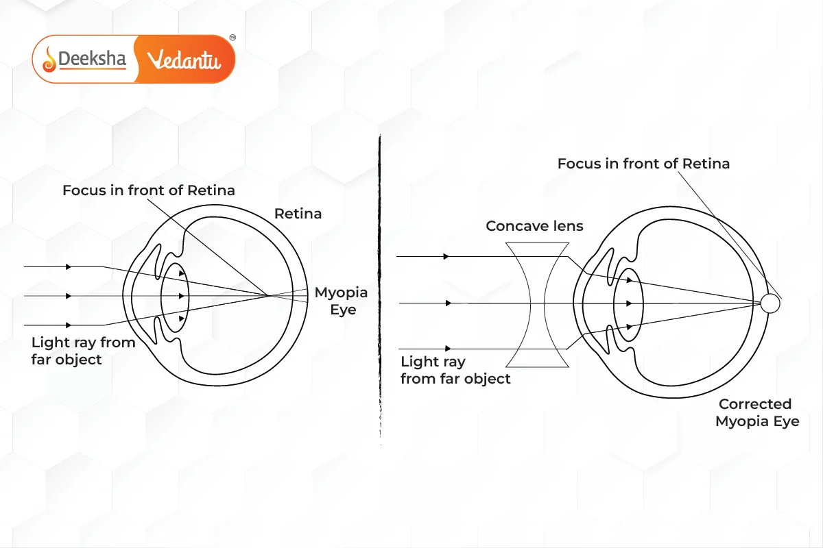 Correction of Myopia