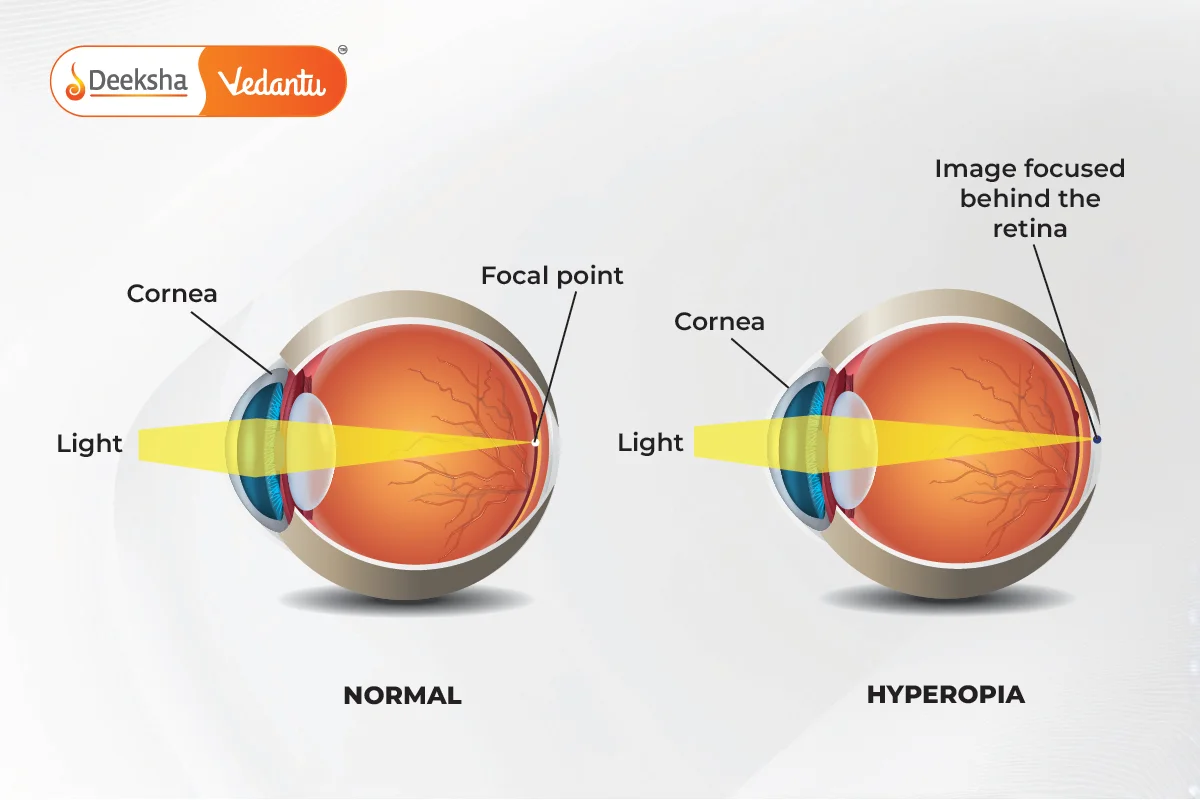 Hypermetropia (Far-Sightedness)