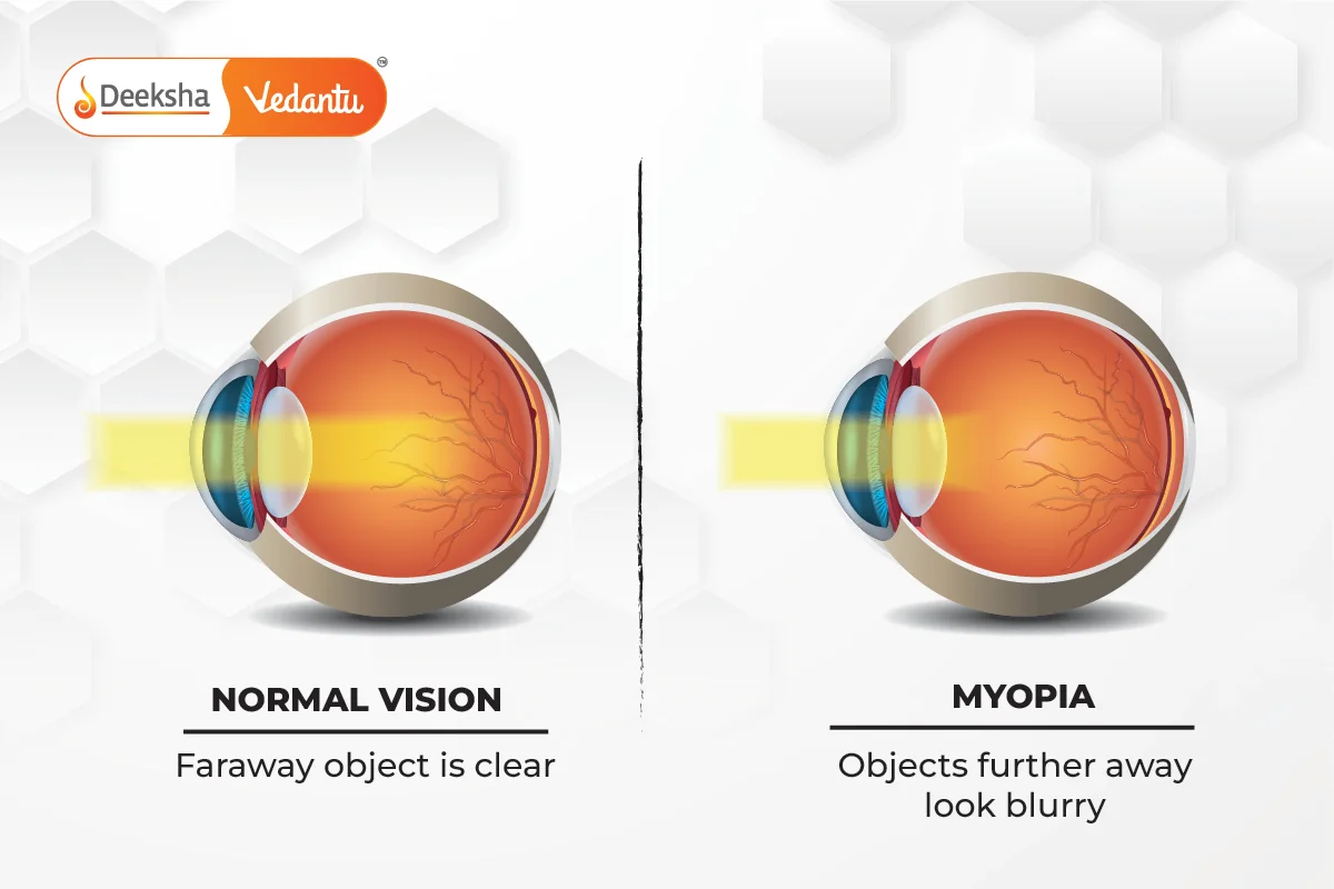 Myopia (Near-Sightedness)